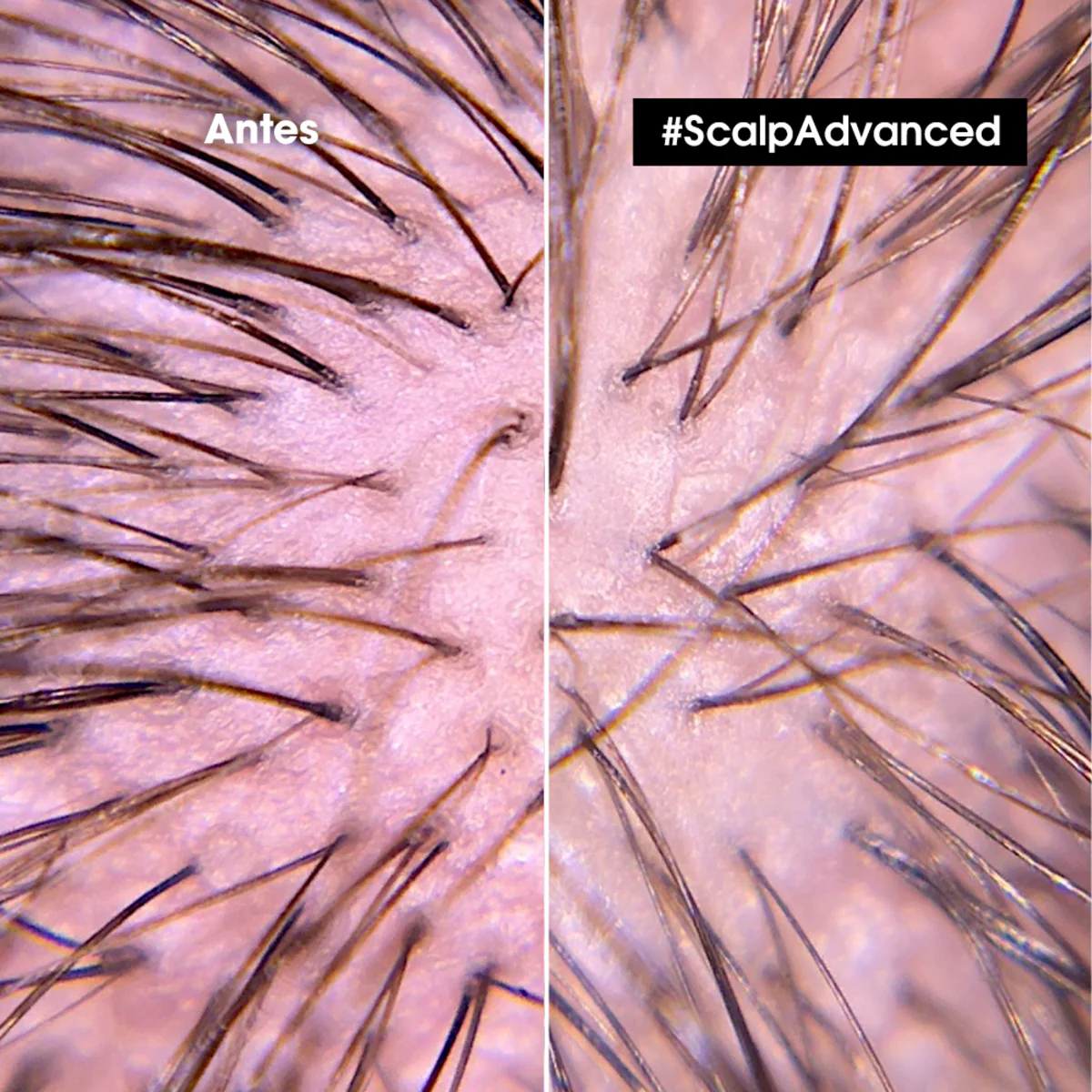 Gel Ligero Para Calmar Y Aliviar De Forma Intensa E Instantánea Las Molestias Del Cuero Cabelludo Scalp Advanced Anti Discomfort 200 Ml Loreal Professionnel - Image 3